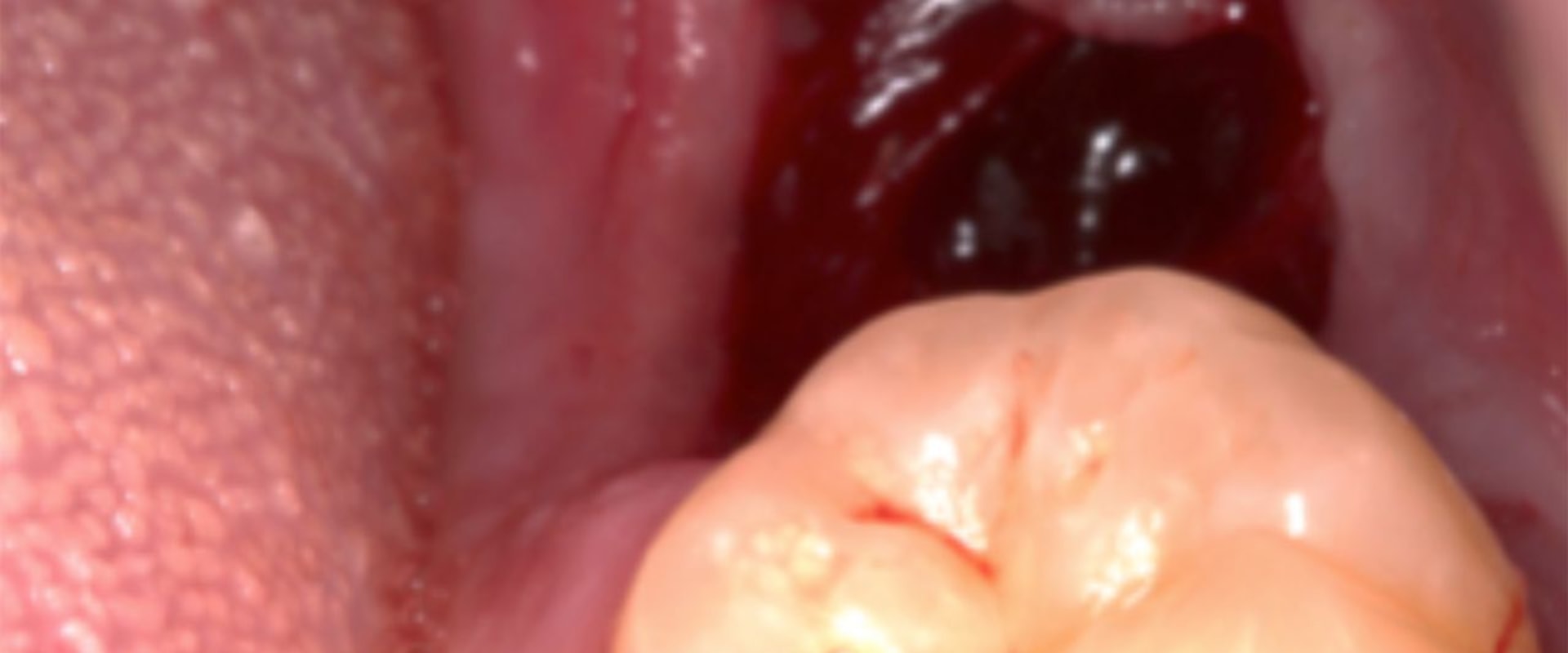 What to Do if You Experience Bleeding After a Tooth Extraction