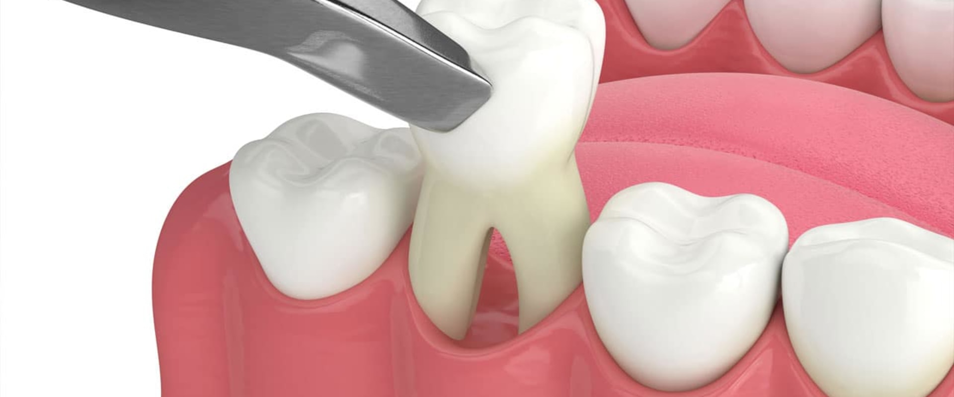 How to Reduce Pain and Swelling After a Tooth Extraction
