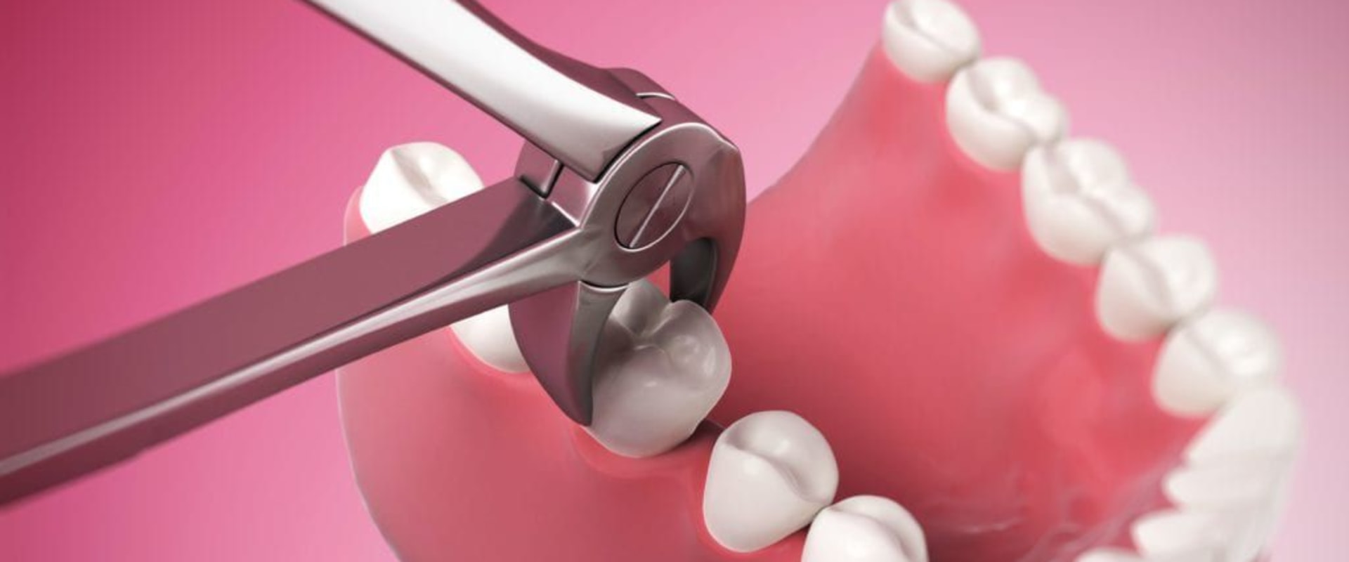 What is the Difference Between Simple and Surgical Tooth Extractions?