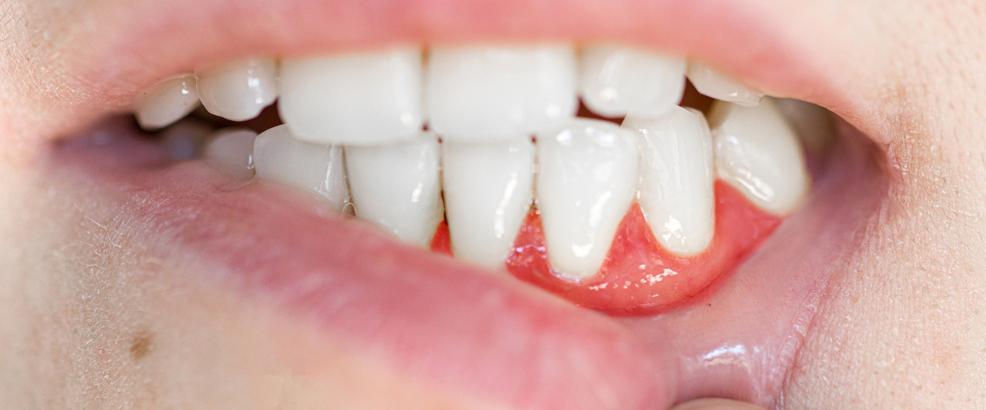 How to Get Rid of an Abscess After Tooth Extraction