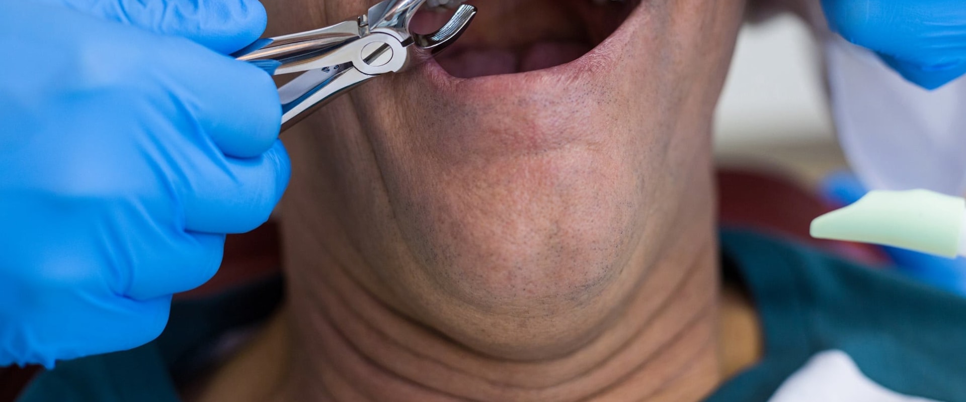 Everything You Need to Know About Tooth Extraction