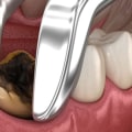 What Happens During a Tooth Extraction Procedure?