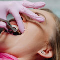 Understanding The Necessity Of Tooth Extraction In Spring Branch: What You Need To Know