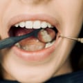 Choosing The Right Dental Clinic For Tooth Extraction In Woden: Here's What To Consider