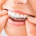 Maximizing Invisalign Results With Strategic Tooth Extraction In Georgetown