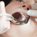 Understanding The Process: A Comprehensive Guide To Tooth Extraction In Sydney