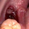 What to Do if You Experience Bleeding After a Tooth Extraction