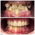 Cosmetic Dentistry in Switzerland After Tooth Extraction: Restoring Natural Smiles