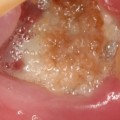 Signs of Infection After Tooth Extraction: What to Look Out For