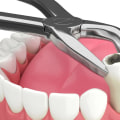 Tooth Extraction and the Importance of Careful Evaluation