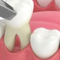 How to Reduce Pain and Swelling After a Tooth Extraction