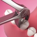 What is the Difference Between Simple and Surgical Tooth Extractions?