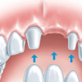 Alternatives to Tooth Extraction: What You Need to Know