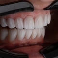 Understanding The Necessity Of Tooth Extraction Before Dental Implants In Manassas, VA