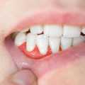 Home Remedies for Abscess After Tooth Extraction