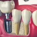 How Dental Implants Can Restore Your Smile After Tooth Extraction In Monroe, LA