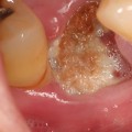 Can I Get an Infection from a Tooth Extraction?
