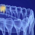 What are the Steps of Tooth Extraction? A Comprehensive Guide