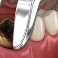 How to Stop Throbbing Pain After Tooth Extraction