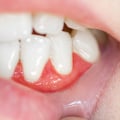 How to Get Rid of an Abscess After Tooth Extraction