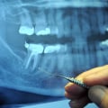 Root Canal vs Tooth Extraction: What's the Difference?