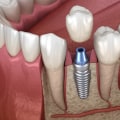 Replacing Missing Teeth: Tooth Extraction And Dental Implants In Austin, TX
