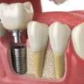 How To Prepare For Dental Implant Surgery After Tooth Extraction In Cedar Park, TX