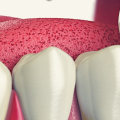 What To Expect During A Tooth Extraction Procedure With An Austin Emergency Dentist