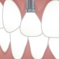 Restore Your Smile with Implants After Tooth Extraction