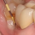 Will an Abscess Go Away After Tooth Extraction?
