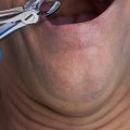 Everything You Need to Know About Tooth Extraction