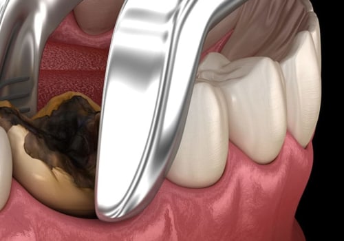 What to Expect After a Tooth Extraction: Pain, Swelling, and More