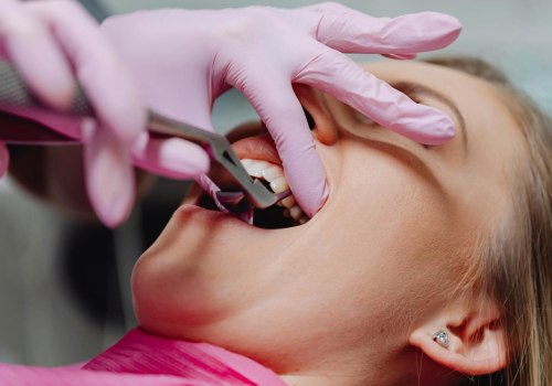 Understanding The Necessity Of Tooth Extraction In Spring Branch: What You Need To Know