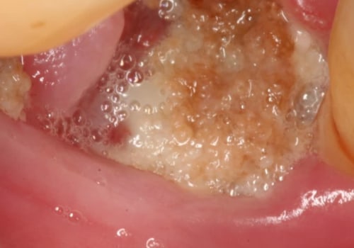 Signs of Infection After Tooth Extraction