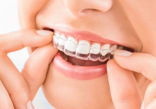 Maximizing Invisalign Results With Strategic Tooth Extraction In Georgetown