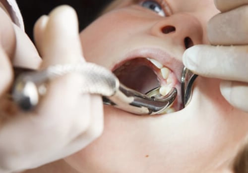 Understanding The Process: A Comprehensive Guide To Tooth Extraction In Sydney