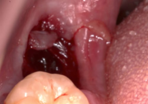 What to Do if You Experience Bleeding After a Tooth Extraction