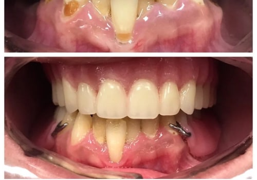Cosmetic Dentistry in Switzerland After Tooth Extraction: Restoring Natural Smiles