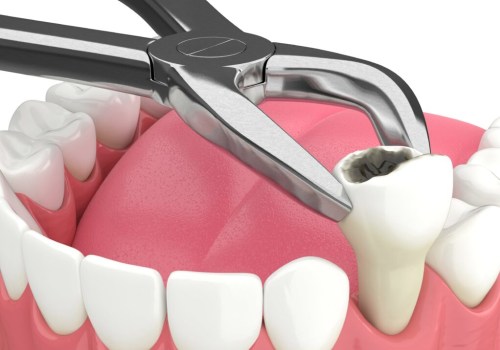 Tooth Extraction and the Importance of Careful Evaluation