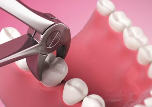 What is the Difference Between Simple and Surgical Tooth Extractions?