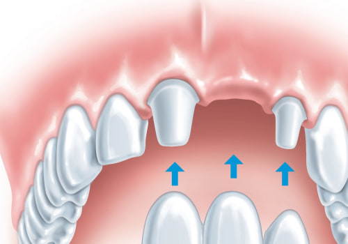 Alternatives to Tooth Extraction: What You Need to Know