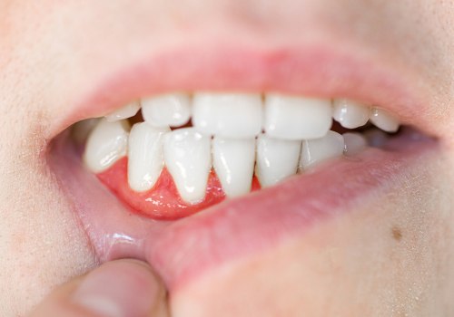 Home Remedies for Abscess After Tooth Extraction