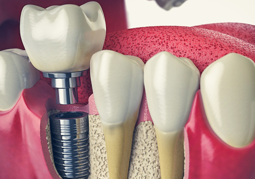 How Dental Implants Can Restore Your Smile After Tooth Extraction In Monroe, LA