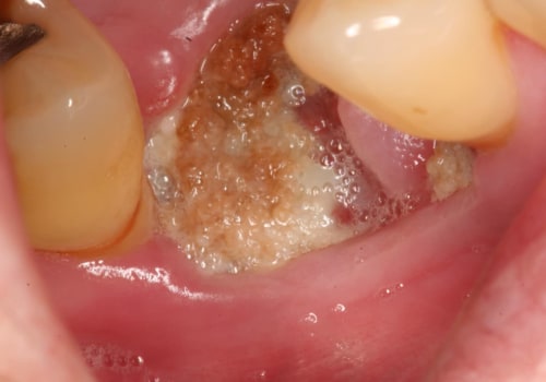 Can I Get an Infection from a Tooth Extraction?