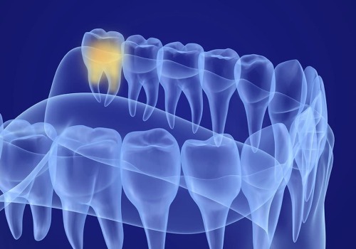 What are the Steps of Tooth Extraction? A Comprehensive Guide