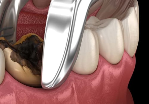 How to Stop Throbbing Pain After Tooth Extraction