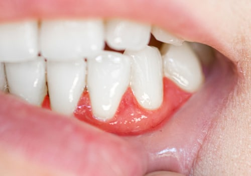 How to Get Rid of an Abscess After Tooth Extraction