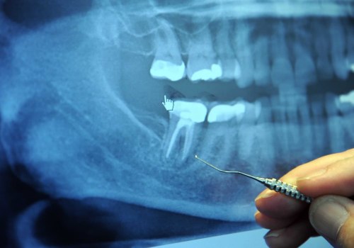 Root Canal vs Tooth Extraction: What's the Difference?