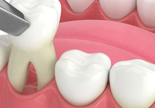 The Best Pain Relief After Tooth Extraction