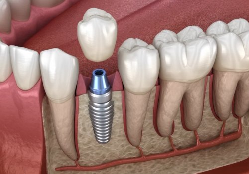 Replacing Missing Teeth: Tooth Extraction And Dental Implants In Austin, TX